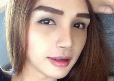 ศัลยกรรมจมูก เสริมจมูก ทำจมูก NYCclinic รีวิวเสริมจมูก ร้อยไหมจมูก เสริมจมูก โปรโมชั่น Promotion NYCclinic รีวิวร้อยไหมจมูก แก้ไหมจมูก