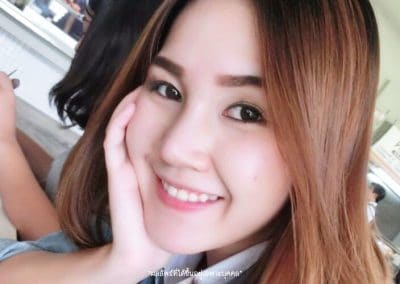 ศัลยกรรมจมูก เสริมจมูก ทำจมูก NYCclinic รีวิวเสริมจมูก