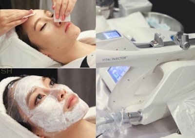เติมวิตามินผิวขาวใส MYCELLREJUVENATION (prp) ผิวขาวกระจ่างใส ลดริ้วรอย ลดรอยดำ