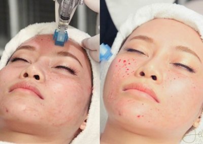 เติมวิตามินผิวขาวใส MYCELLREJUVENATION (prp) ผิวขาวกระจ่างใส ลดริ้วรอย ลดรอยดำ