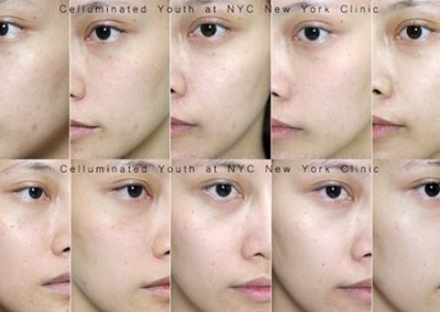 เติมวิตามินผิวขาวใส MYCELLREJUVENATION (prp) ผิวขาวกระจ่างใส ลดริ้วรอย ลดรอยดำ