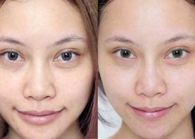 เติมวิตามินผิวขาวใส MYCELLREJUVENATION (prp) ผิวขาวกระจ่างใส ลดริ้วรอย ลดรอยดำ