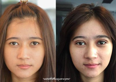 ศัลยกรรมตา 2 ชั้น ทำตา 2 ชั้น รีวิวทำตา 2 ชั้น รีวิวศัลยกรรมตา 2 ชั้น NYCclinic