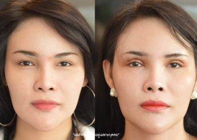 ศัลยกรรมตา 2 ชั้น ทำตา 2 ชั้น รีวิวทำตา 2 ชั้น รีวิวศัลยกรรมตา 2 ชั้น NYCclinic