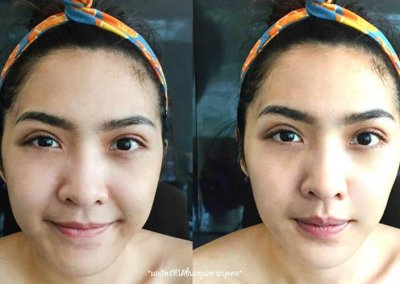 ศัลยกรรมตา 2 ชั้น ทำตา 2 ชั้น รีวิวทำตา 2 ชั้น รีวิวศัลยกรรมตา 2 ชั้น NYCclinic