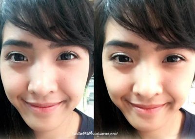 ศัลยกรรมตา 2 ชั้น ทำตา 2 ชั้น รีวิวทำตา 2 ชั้น รีวิวศัลยกรรมตา 2 ชั้น NYCclinic