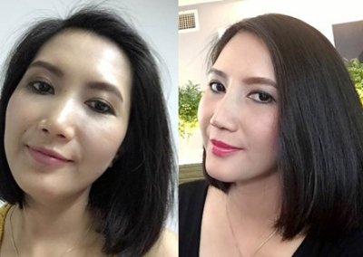 ศัลยกรรมจมูก เสริมจมูก ทำจมูก NYCclinic รีวิวเสริมจมูก