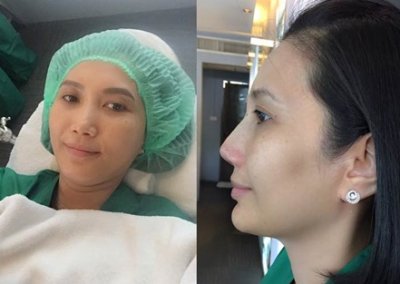 ศัลยกรรมจมูก เสริมจมูก ทำจมูก NYCclinic รีวิวเสริมจมูก