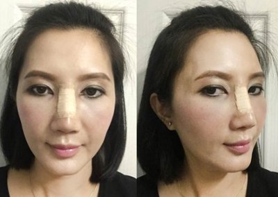 ศัลยกรรมจมูก เสริมจมูก ทำจมูก NYCclinic รีวิวเสริมจมูก