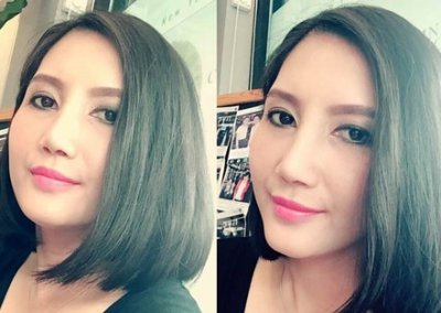 ศัลยกรรมจมูก เสริมจมูก ทำจมูก NYCclinic รีวิวเสริมจมูก