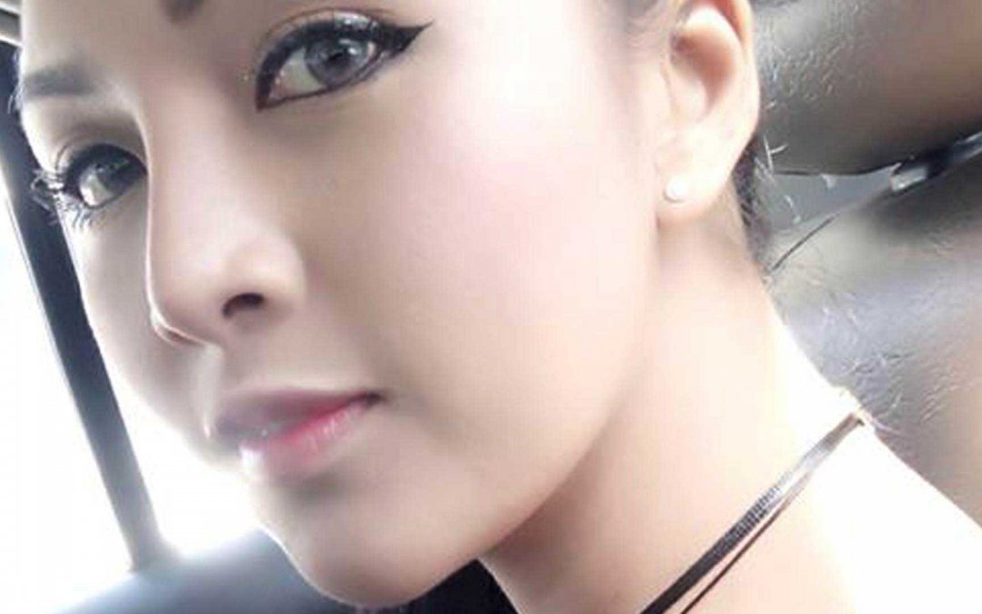 Review chin augmentation silicone 3 weeks at NYC New York Clinic