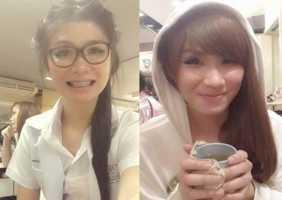 เสริมคางไม่ซาละเปาแต่มีคาง ศัลยกรรมคาง เสริมคาง ทำคาง โปรโมชั่น Promotion NYCclinic รีวิวศัลยกรรมคาง รีวิวทำคาง