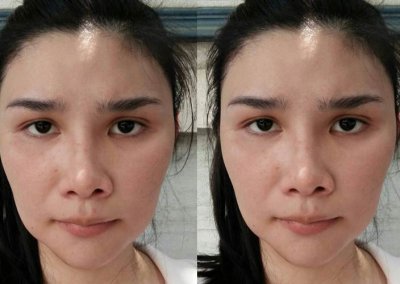 เสริมคางไม่ซาละเปาแต่มีคาง ศัลยกรรมคาง เสริมคาง ทำคาง โปรโมชั่น Promotion NYCclinic รีวิวศัลยกรรมคาง รีวิวทำคาง