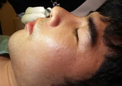 ศัลยกรรมจมูก เสริมจมูกผู้ชาย เสริมจมูก ทำจมูก NYCclinic รีวิวเสริมจมูก