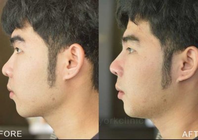 mennose-beforeafter ศัลยกรรมจมูก เสริมจมูกผู้ชาย เสริมจมูก ทำจมูก NYCclinic รีวิวเสริมจมูก