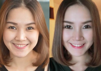 ศัลยกรรมจมูก เสริมจมูก ทำจมูก NYCclinic รีวิวเสริมจมูก