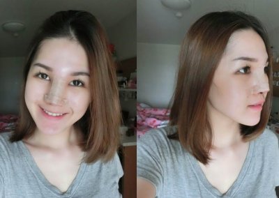 ศัลยกรรมจมูก เสริมจมูก ทำจมูก NYCclinic รีวิวเสริมจมูก