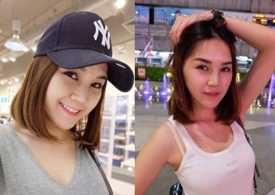 ศัลยกรรมจมูก เสริมจมูก ทำจมูก NYCclinic รีวิวเสริมจมูก