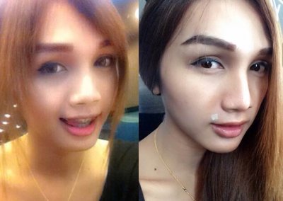 ร้อยไหมจมูก เสริมจมูก โปรโมชั่น Promotion NYCclinic รีวิวร้อยไหมจมูก แก้ไหมจมูก