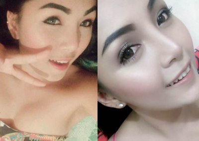 เสริมคาง 3 อาทิตย์ โปรโมชั่น Promotion NYCclinic รีวิวศัลยกรรมคาง รีวิวทำคาง