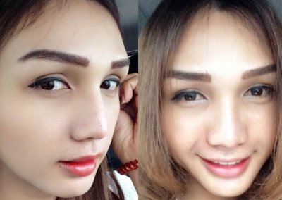 ร้อยไหมจมูก เสริมจมูก โปรโมชั่น Promotion MYCELLREJUVENATION (prp) ผิวขาวกระจ่างใส ลดริ้วรอย ลดรอยดำ หน้าเรียว ลดริ้วรอย HIFU ยกกระชับผิวหย่อนคล้อย ไม่เจ็บ ไม่บวม BUCCAL FAT ตัดไขมันกระพุ้งแก้ม V-SHAPE THREAD LIFTING ร้อยไหมวีเชฟ ใบหน้าเรียว ตึง ยกกระชับ ไม่เขียวช้ำ VITAMIN IV DRIP THERAPY ฉีดวิตามิน ผิวเนียนใส ศัลยกรรมตา 2 ชั้น ทำตา 2 ชั้น ศัลยกรรมคาง เสริมคาง ทำคาง ศัลยกรรมจมูก เสริมจมูก ทำจมูก NYCclinic รีวิวร้อยไหมจมูก