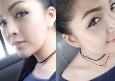 เสริมคาง 3 อาทิตย์ โปรโมชั่น Promotion NYCclinic รีวิวศัลยกรรมคาง รีวิวทำคาง
