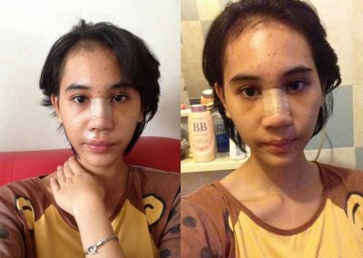 nosejob ศัลยกรรมจมูก เสริมจมูก ทำจมูก NYCclinic รีวิวเสริมจมูก