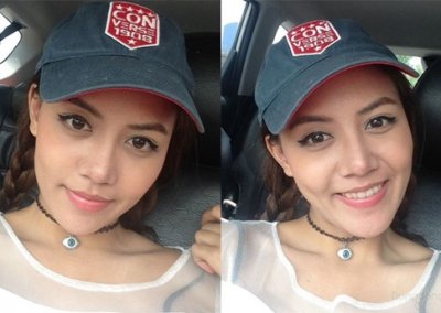 ประสบการณ์แก้จมูกครั้งที่ 2-1 ศัลยกรรมจมูก เสริมจมูก ทำจมูก NYCclinic แก้จมูก รีวิวเสริมจมูก