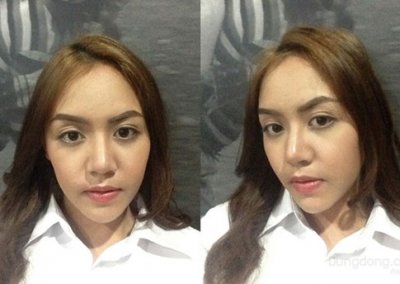 ประสบการณ์แก้จมูกครั้งที่ 2-2 ศัลยกรรมจมูก เสริมจมูก ทำจมูก NYCclinic แก้จมูก รีวิวเสริมจมูก