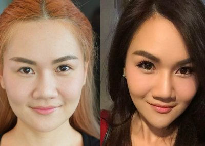 เสริมคางเฟีย2 โปรโมชั่น Promotion NYCclinic รีวิวศัลยกรรมคาง รีวิวทำคาง