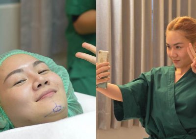 เสริมคางเฟีย3 โปรโมชั่น Promotion NYCclinic รีวิวศัลยกรรมคาง รีวิวทำคาง