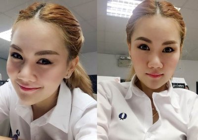 เสริมคางเฟีย5 โปรโมชั่น Promotion NYCclinic รีวิวศัลยกรรมคาง รีวิวทำคาง
