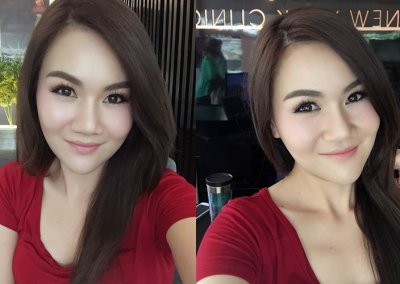 เสริมคางเฟีย6 โปรโมชั่น Promotion NYCclinic รีวิวศัลยกรรมคาง รีวิวทำคาง