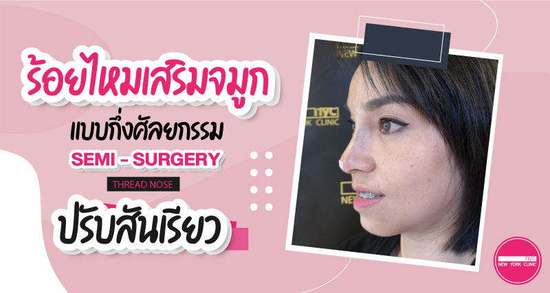 ปรับสันเรียว ด้วยการร้อยไหมจมูกกึ่งศัลยกรรม