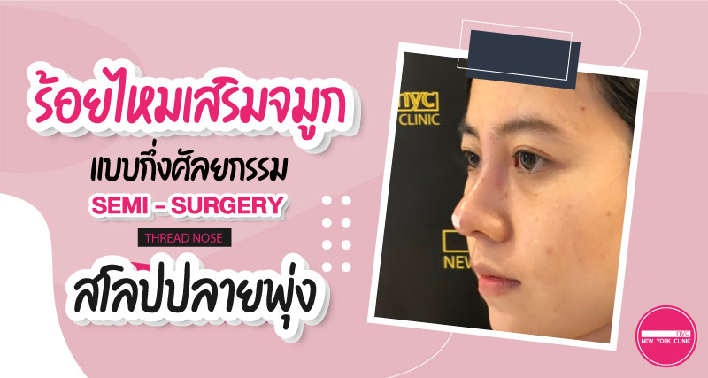 สโลปปลายพุ่ง ด้วยการร้อยไหมจมูกกึ่งศัลยกรรม