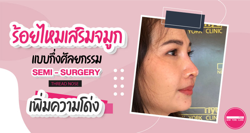 เพิ่มความโด่ง ด้วยการร้อยไหมจมูกกึ่งศัลยกรรม