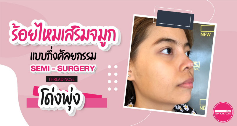 โด่งพุ่ง ด้วยการร้อยไหมจมูกกึ่งศัลยกรรม