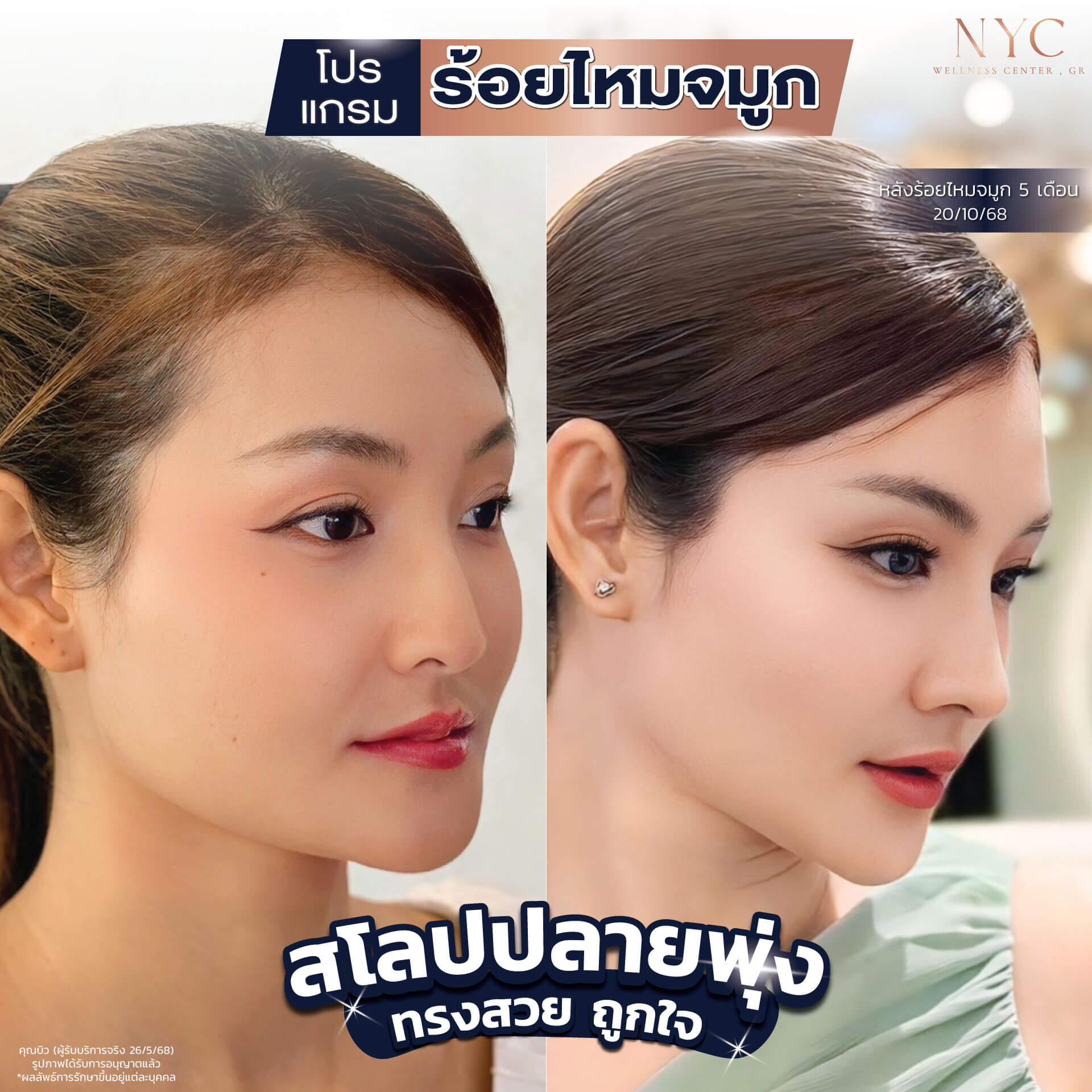 โปรแกรมร้อยไหมจมูกWEB_0