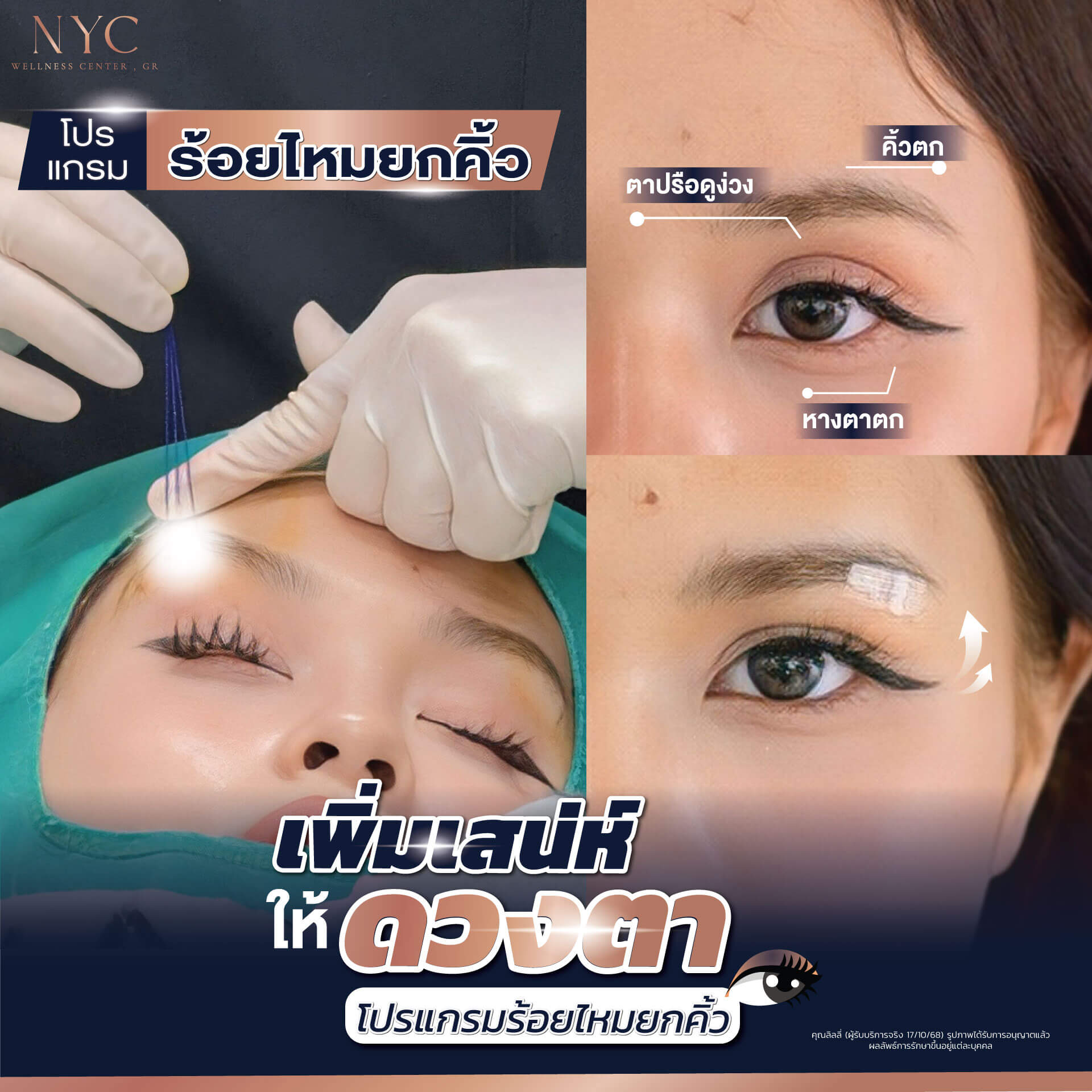 โปรแกรมร้อยไหมยกคิ้วWEB_0