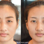 ศัลยกรรมตา 2 ชั้น ทำตา 2 ชั้น รีวิวทำตา 2 ชั้น รีวิวศัลยกรรมตา 2 ชั้น NYCclinic