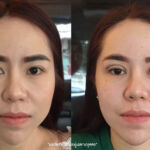 ศัลยกรรมตา 2 ชั้น ทำตา 2 ชั้น รีวิวทำตา 2 ชั้น รีวิวศัลยกรรมตา 2 ชั้น NYCclinic