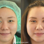 ศัลยกรรมตา 2 ชั้น ทำตา 2 ชั้น รีวิวทำตา 2 ชั้น รีวิวศัลยกรรมตา 2 ชั้น NYCclinic