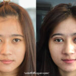ศัลยกรรมตา 2 ชั้น ทำตา 2 ชั้น รีวิวทำตา 2 ชั้น รีวิวศัลยกรรมตา 2 ชั้น NYCclinic