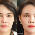 ศัลยกรรมตา 2 ชั้น ทำตา 2 ชั้น รีวิวทำตา 2 ชั้น รีวิวศัลยกรรมตา 2 ชั้น NYCclinic