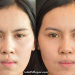 ศัลยกรรมตา 2 ชั้น ทำตา 2 ชั้น รีวิวทำตา 2 ชั้น รีวิวศัลยกรรมตา 2 ชั้น NYCclinic
