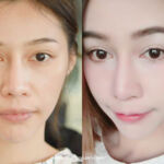 ร้อยไหมจมูก เสริมจมูก โปรโมชั่น Promotion MYCELLREJUVENATION (prp) ผิวขาวกระจ่างใส ลดริ้วรอย ลดรอยดำ หน้าเรียว ลดริ้วรอย HIFU ยกกระชับผิวหย่อนคล้อย ไม่เจ็บ ไม่บวม BUCCAL FAT ตัดไขมันกระพุ้งแก้ม V-SHAPE THREAD LIFTING ร้อยไหมวีเชฟ ใบหน้าเรียว ตึง ยกกระชับ ไม่เขียวช้ำ VITAMIN IV DRIP THERAPY ฉีดวิตามิน ผิวเนียนใส ศัลยกรรมตา 2 ชั้น ทำตา 2 ชั้น ศัลยกรรมคาง เสริมคาง ทำคาง ศัลยกรรมจมูก เสริมจมูก ทำจมูก NYCclinic รีวิวร้อยไหมจมูก