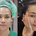 ศัลยกรรมตา 2 ชั้น ทำตา 2 ชั้น รีวิวทำตา 2 ชั้น รีวิวศัลยกรรมตา 2 ชั้น NYCclinic