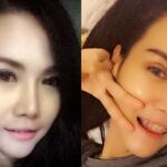 ศัลยกรรมตา 2 ชั้น ทำตา 2 ชั้น รีวิวทำตา 2 ชั้น รีวิวศัลยกรรมตา 2 ชั้น NYCclinic