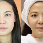 HIFU ยกกระชับผิวหย่อนคล้อย ไม่เจ็บ ไม่บวม NYCclinic รีวิวHIFU