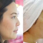 HIFU ยกกระชับผิวหย่อนคล้อย ไม่เจ็บ ไม่บวม NYCclinic รีวิวHIFU